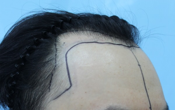 切開3300毛のヘアライン移植をしています