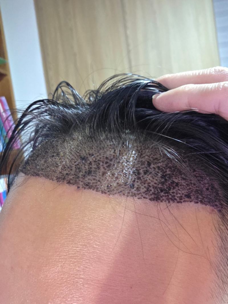 It's the 7th day of the transplant. Let's see if it turned out well