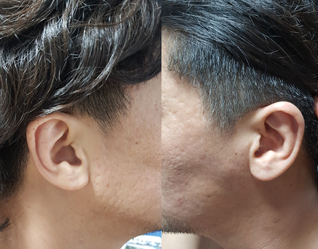 구레나룻 모발이식 어느덧 세달