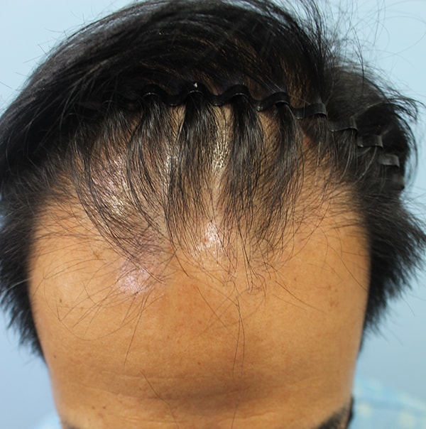 ヘアライン、頭頂部移植後のレビューを残します。