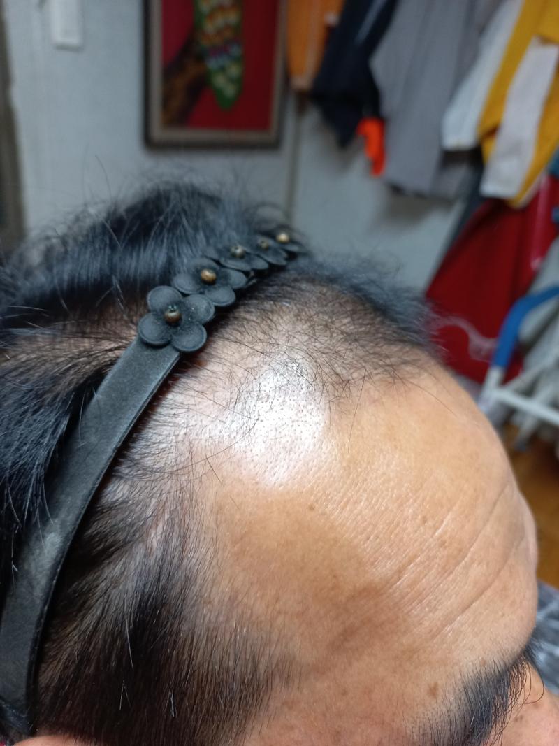 植发后第8天