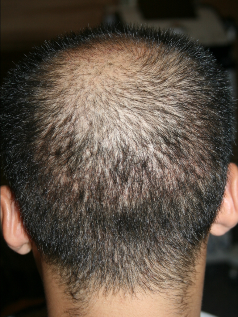 ポヘア毛髪移植センターで手術を受けてから3週目になりました。