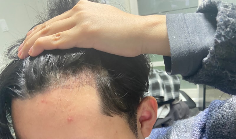 1 month of hair transplant