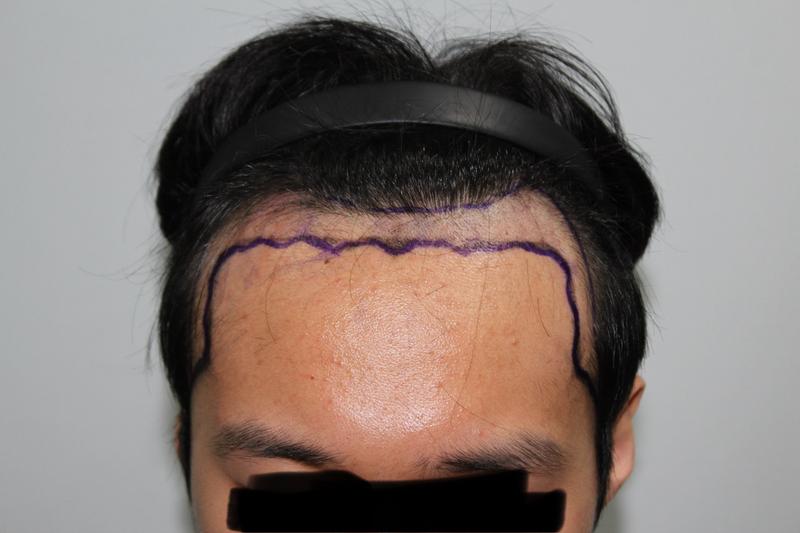 Moat Non-Cutting 1700 Hair follicle hair transplant review (soon after surgery)