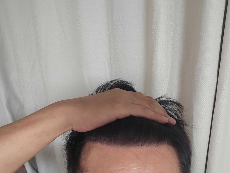 무삭발모발이식2년차.jpg
