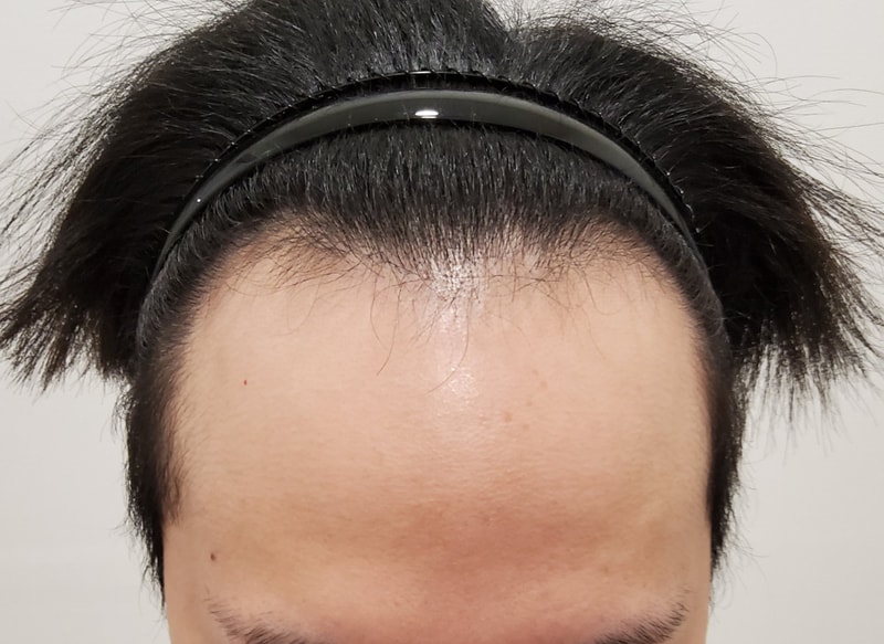 1. 수술전_1.jpg