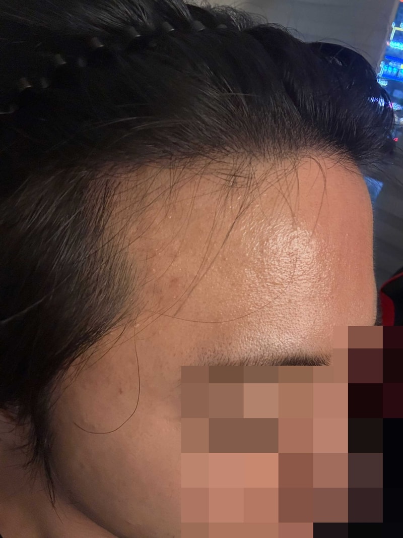 비절개모발이식_16개월.jpg