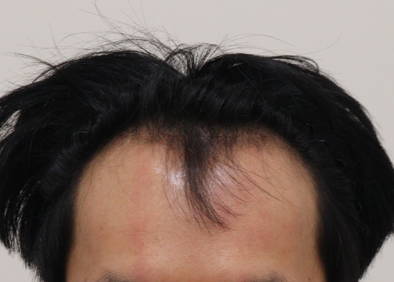 1. 수술전_1.JPG