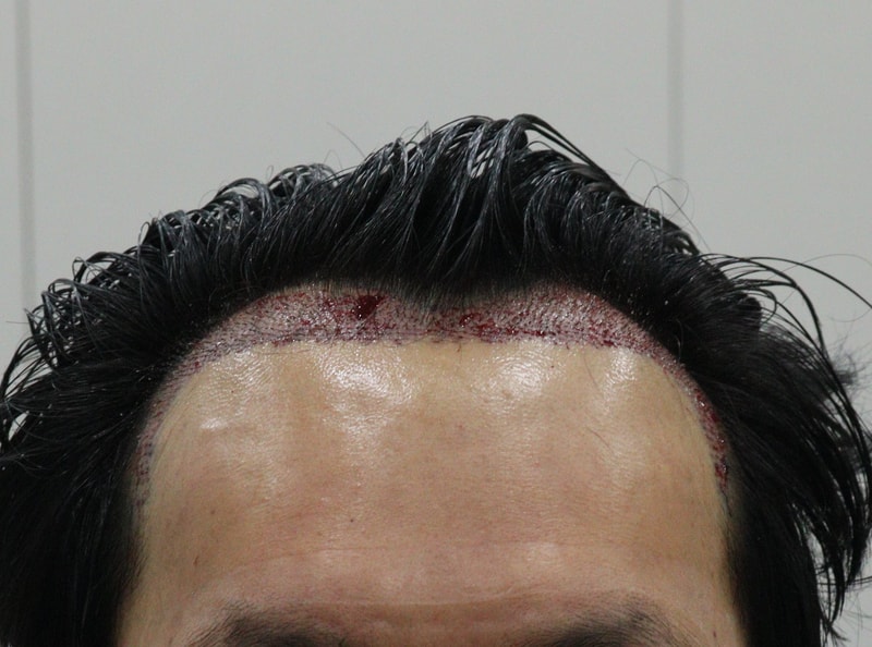 2. 수술후_당일_1.JPG