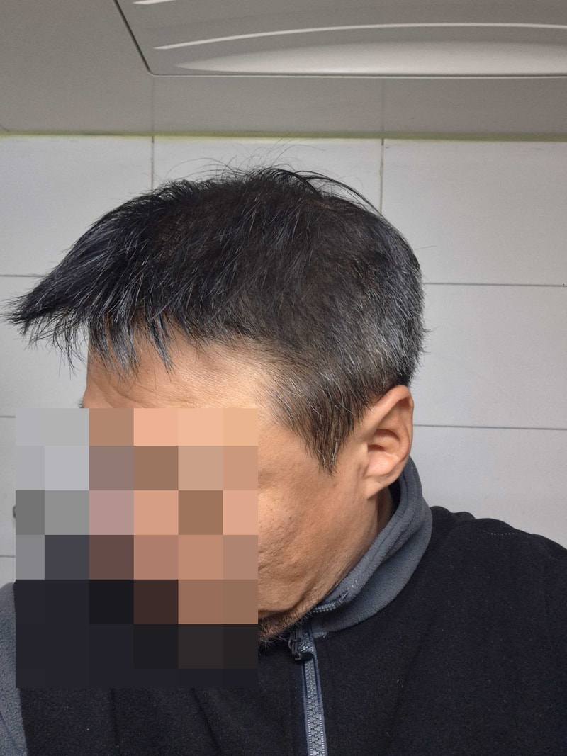 다나성형외과 16개월차 후기/대량탈모 비절개모발이식/추천 여부