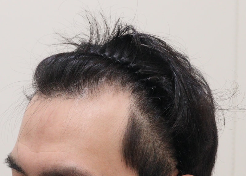1. 수술전_2.JPG
