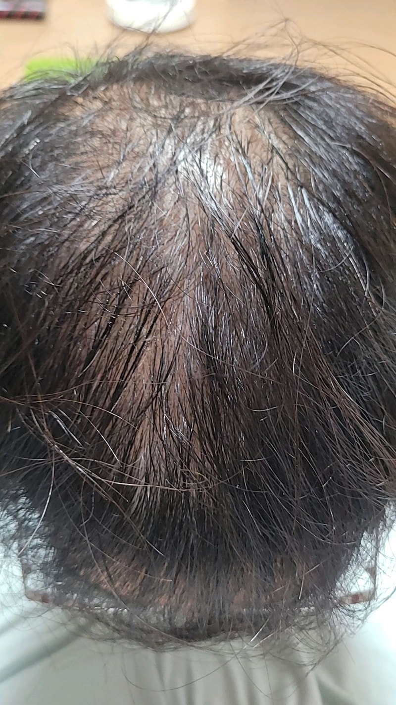 5000모 대량비절개 다나성형외과 16개월2주 경과