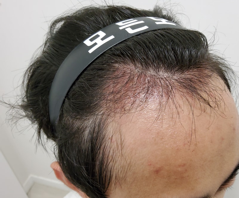 3. 수술후_3개월_3.jpg
