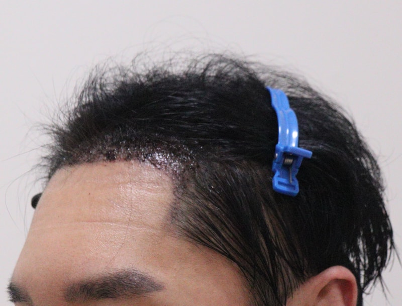 2. 수술후_1일_2.JPG