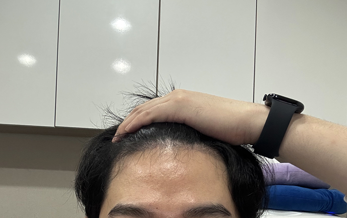 3. 안빠진 머리들은 벌써 이만큼 자랐고 암흑기 끝물이라 그런지 이식모가 보슬보슬 조금씩 올라오고 있어요.jpg