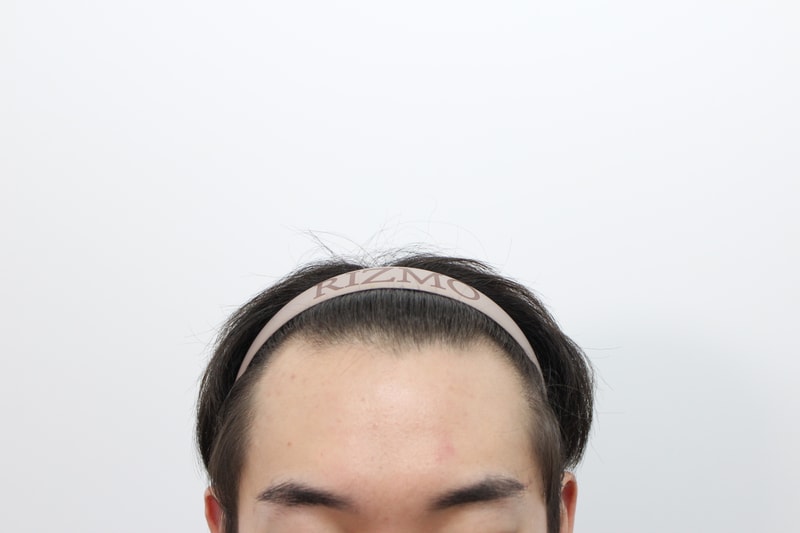 수술 전 정면.jpg
