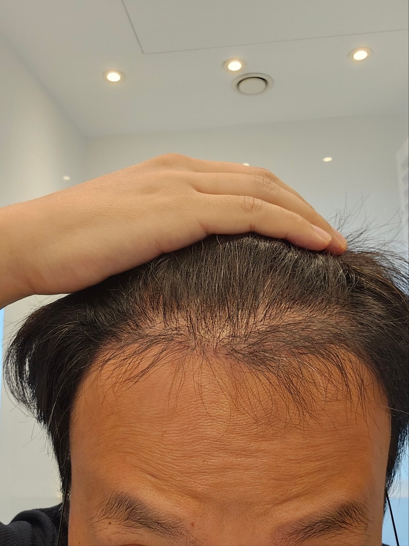 4. 수술후_6개월_셀카_1.jpg