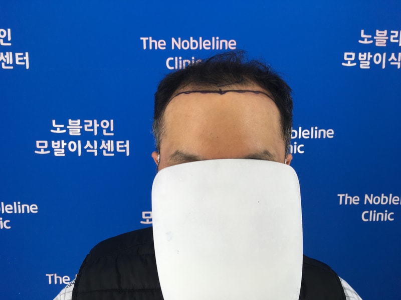 노블라인에서 이식 45일째 입니다.