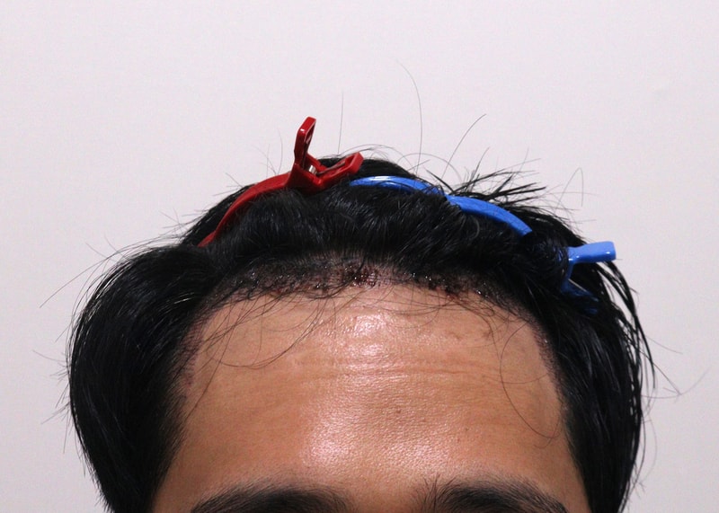 2. 수술후_1일_1.JPG