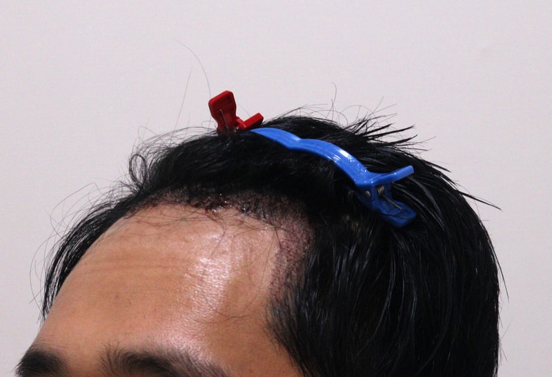 2. 수술후_1일_2.JPG