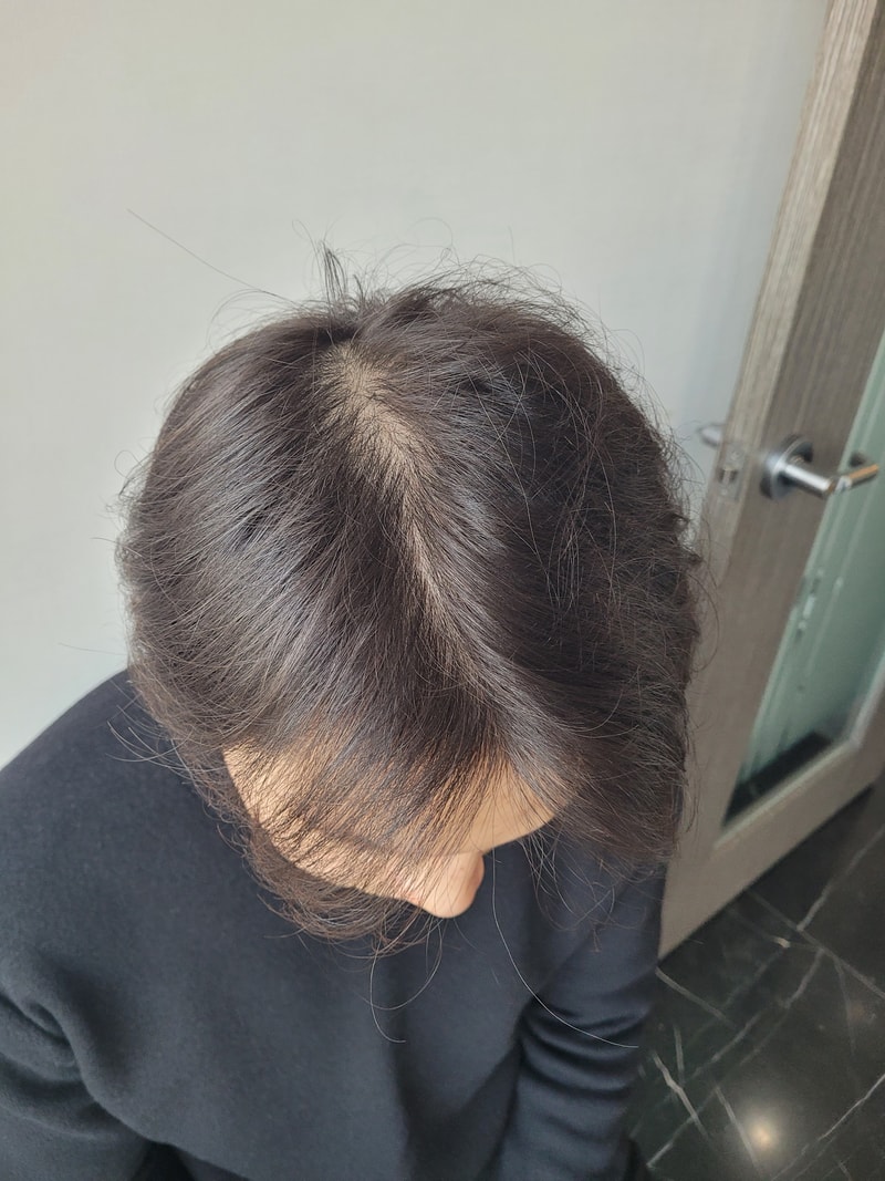 수술 후 1년 경과 후기 올립니다