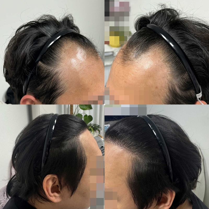 다나성형외과 모발이식 추천 찬양글, 비절개 3400모, 19개월 경과