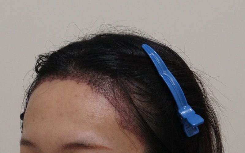 2. 수술후_1일_2.JPG