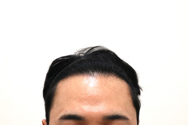 4. 수술후_6개월_1.JPG
