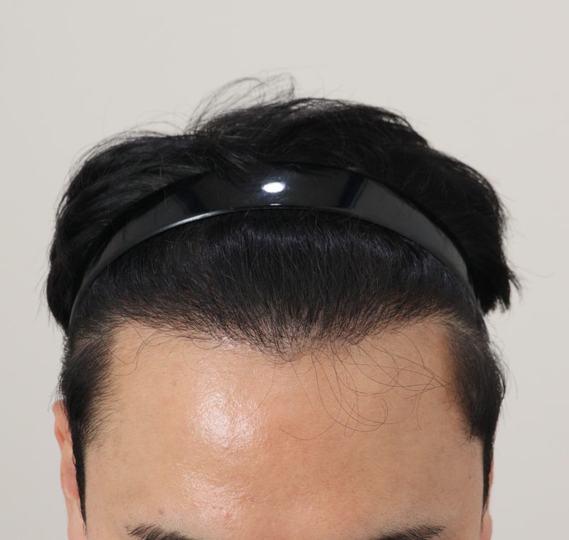 4. 수술후_6개월_2.JPG