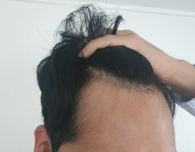 모발이식전2.jpg