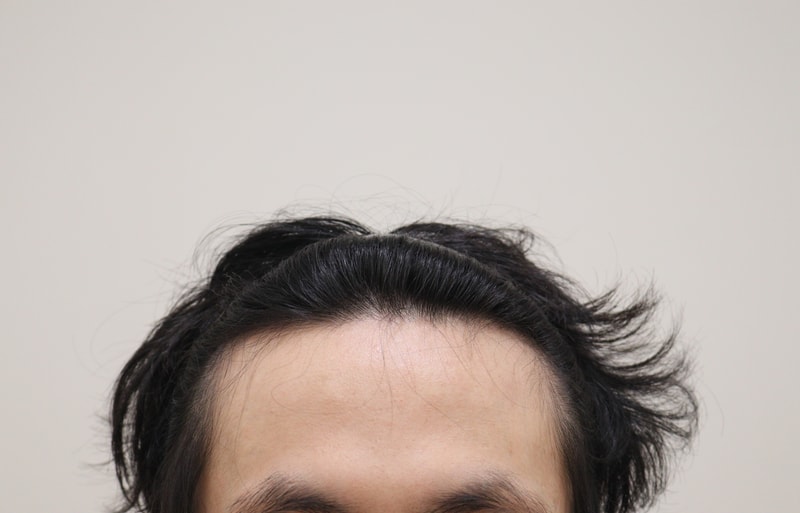 1. 수술전_1.JPG