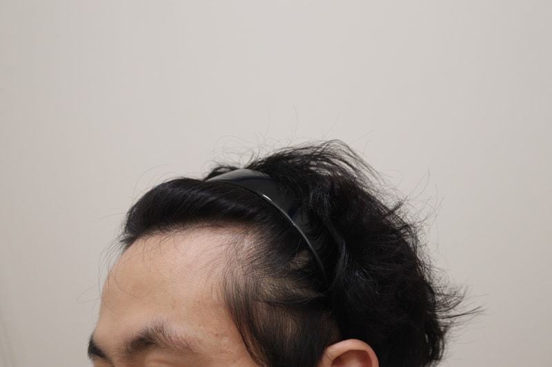 1. 수술전_2.JPG