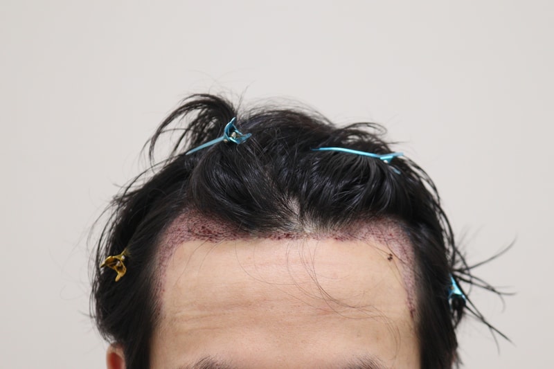 2. 수술후_1일_1.JPG