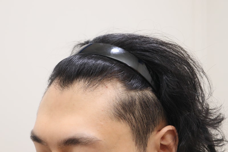 1. 수술전_2.JPG