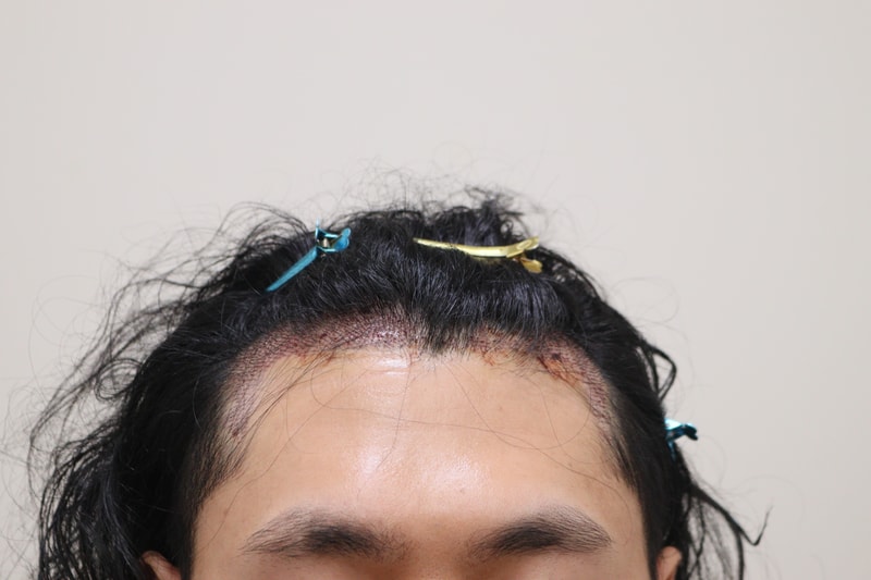 2. 수술후_1일_1.JPG