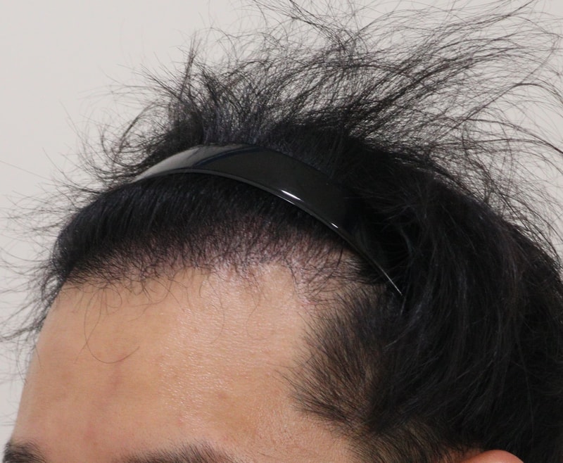 3. 수술후_3개월_2.JPG