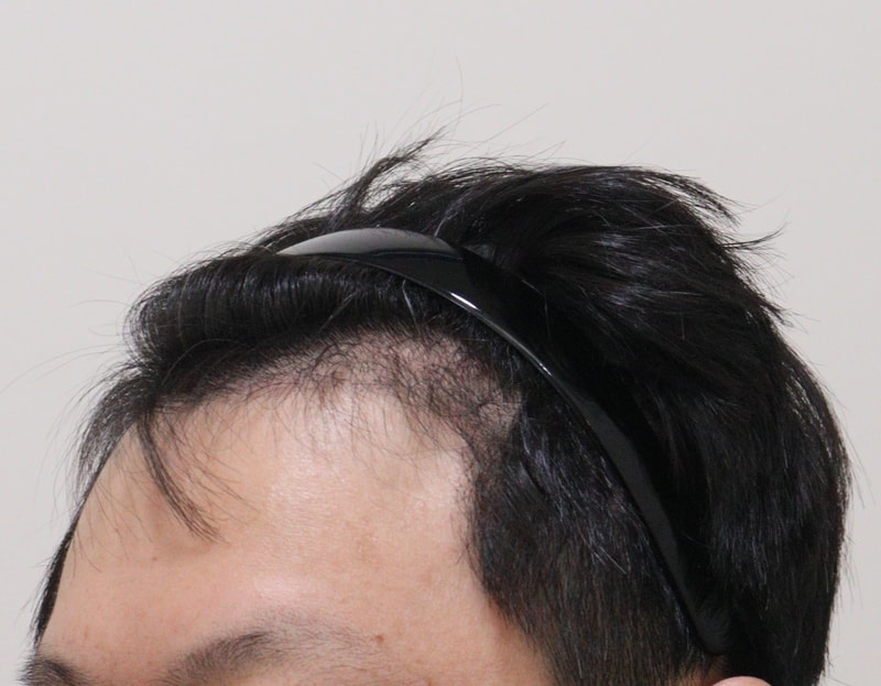 3. 수술후_6개월_2.JPG