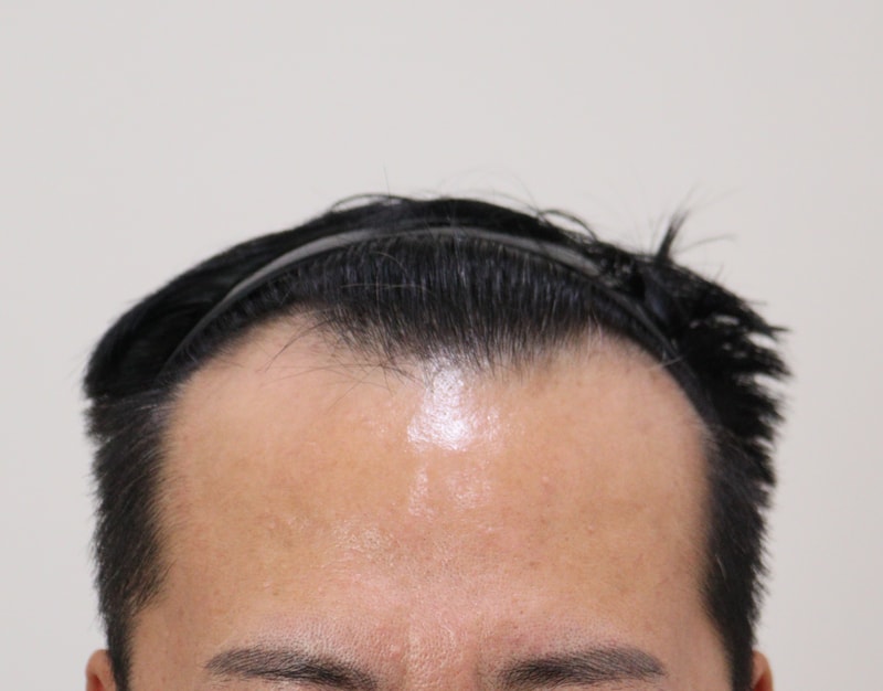 1. 수술전_1.JPG