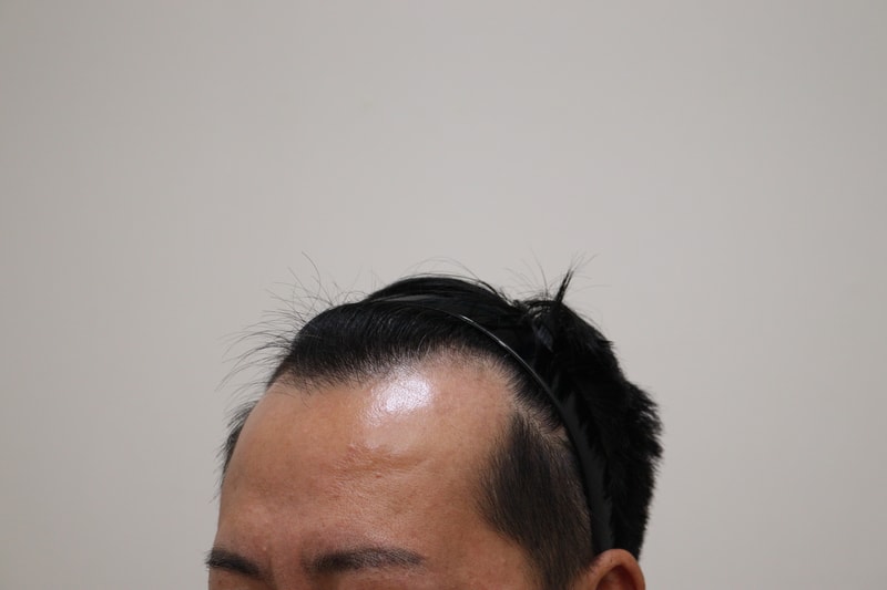 1. 수술전_2.JPG