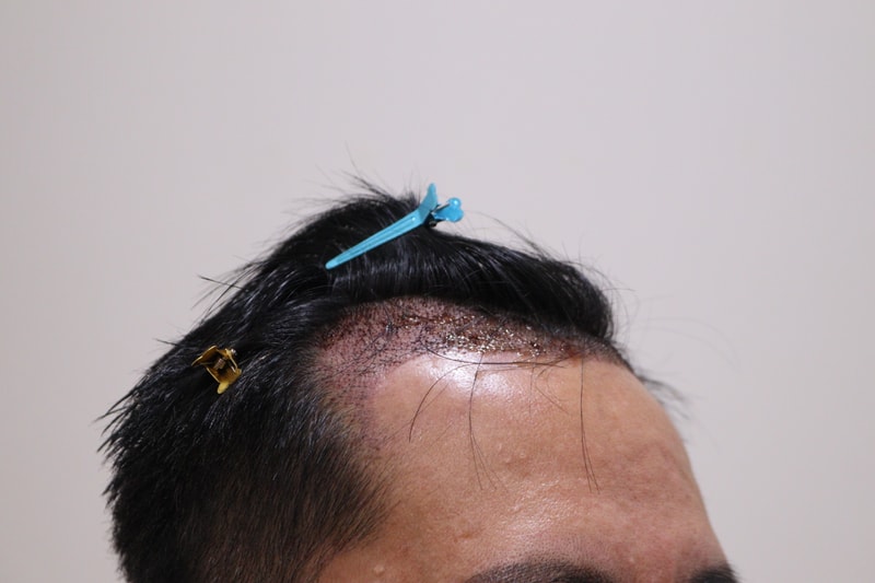 2. 수술후_1일_3.JPG