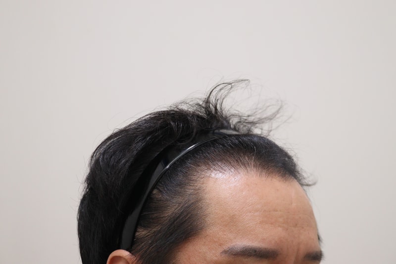 1. 수술전_3.JPG