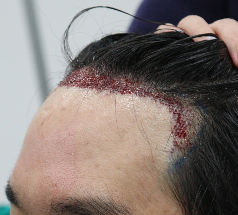 2. 수술후_당일_2.JPG