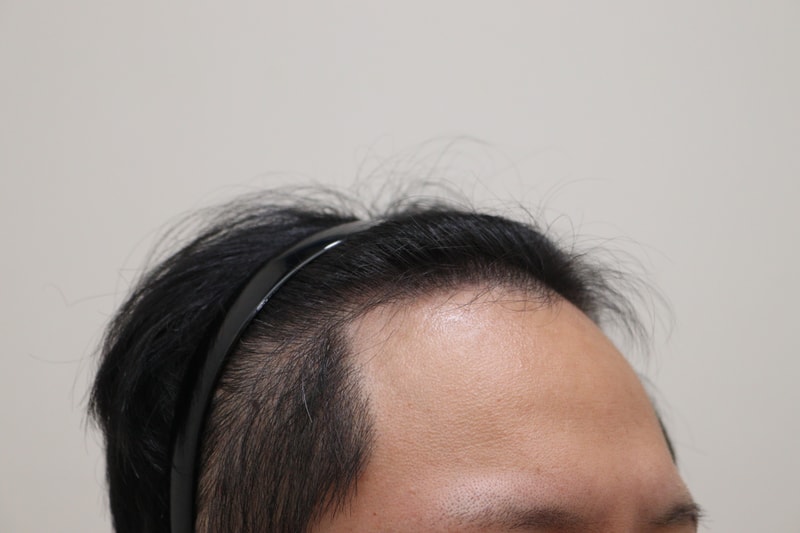 1. 수술전_3.JPG