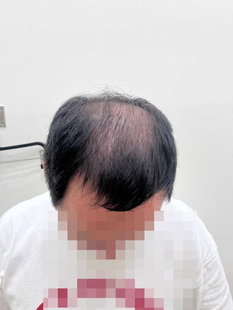 모발이식수술전.jpg