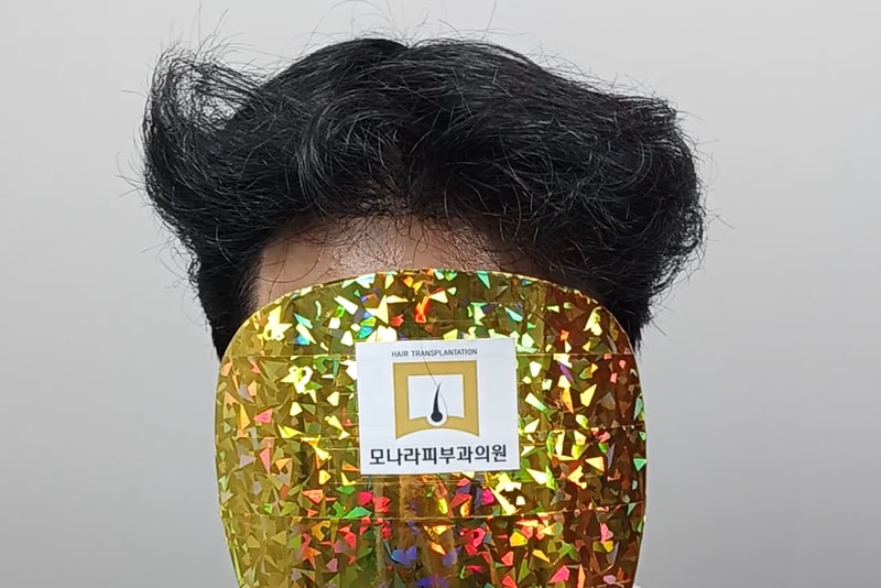 모나라모발이식1년 (3).jpg