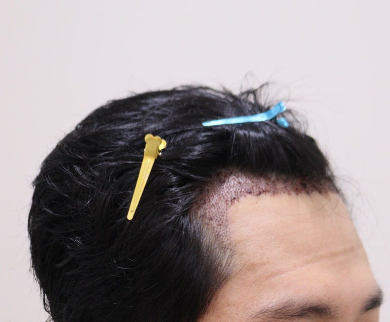 2. 수술후_1일_3.JPG