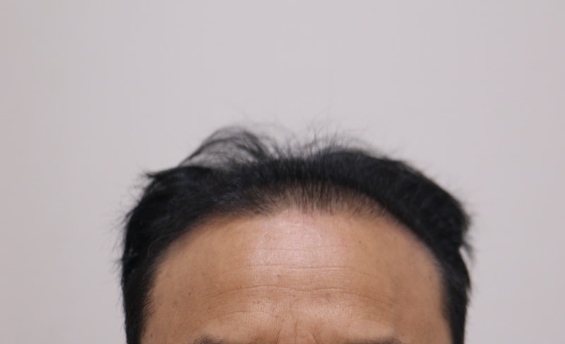 1. 수술전_1.JPG