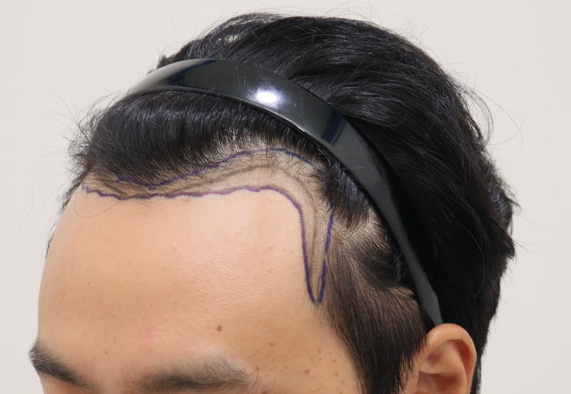 1. 수술전_2.JPG