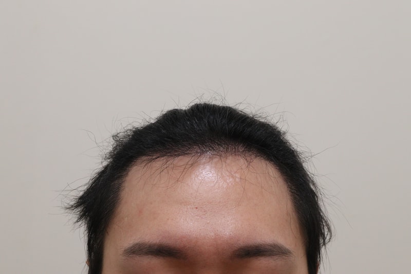 3. 수술후_6개월_1.JPG