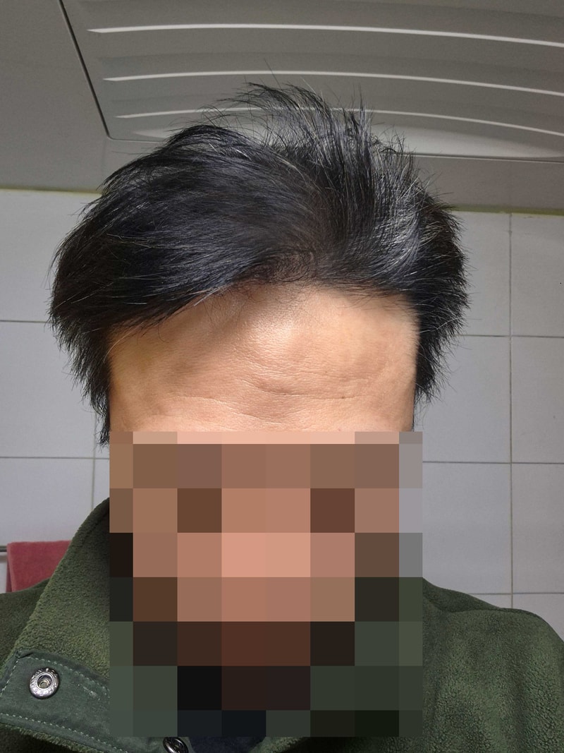 극한 탈모인. 다나성형외과, 2200모낭, 17개월차.